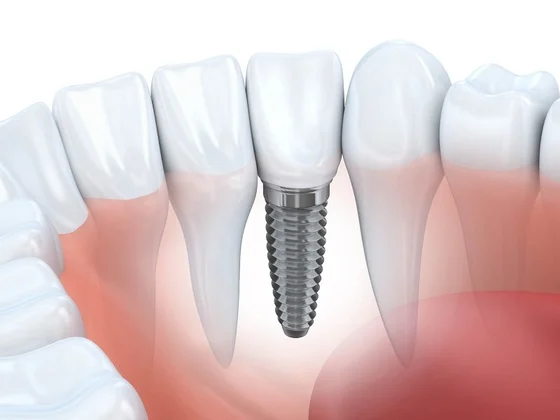 Dental Implants: Why They Might Just Be The Right Option for You