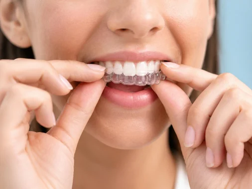 Woman fitting a clear aligner