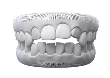 Open bite