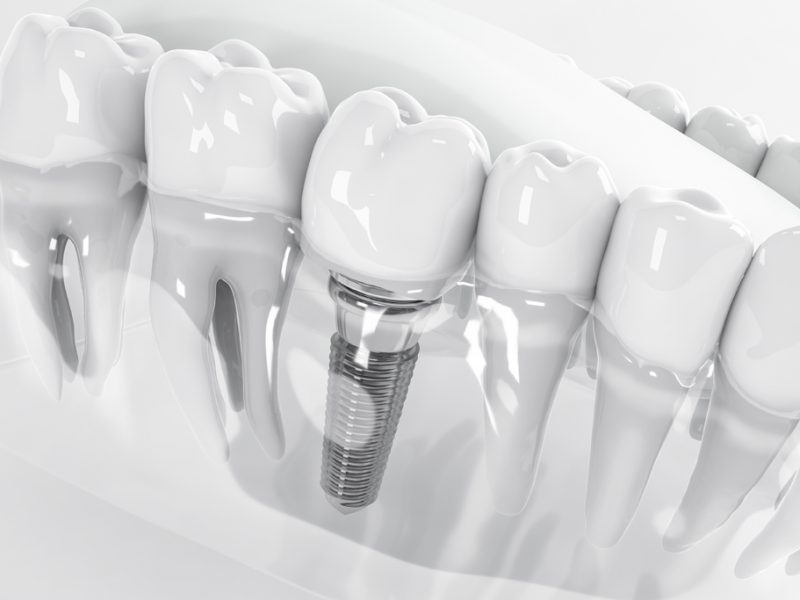 Dental Implants | Smile Club | Dentist in Cheadle Hulme | General Dentistry