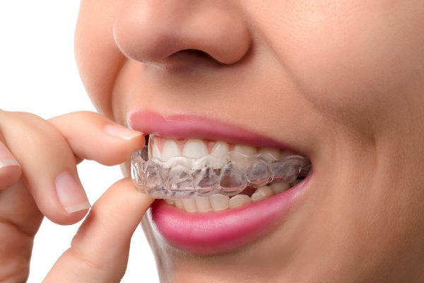 teeth straightening | Smile Club | Dentist in Cheadle Hulme | General Dentistry